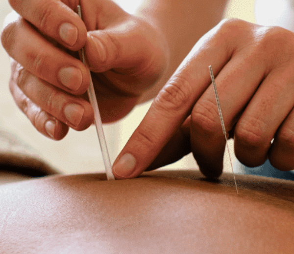 Unidad de Acupuntura en Barcelona